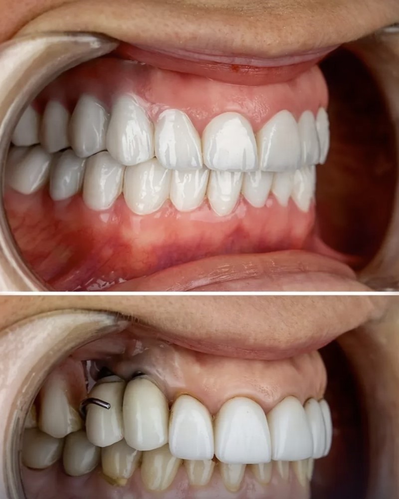 Orthodontics Invisalign